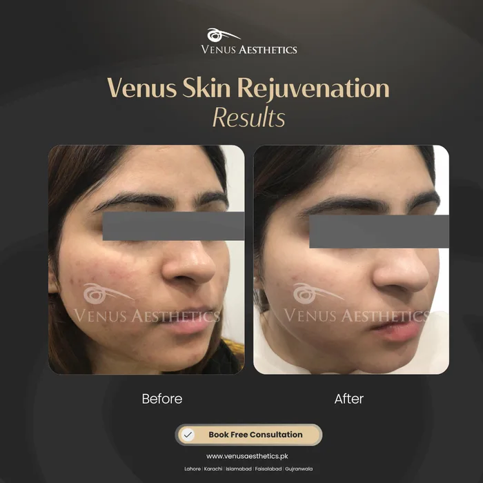 Acne Scars before and after result at Venus Aesthetics