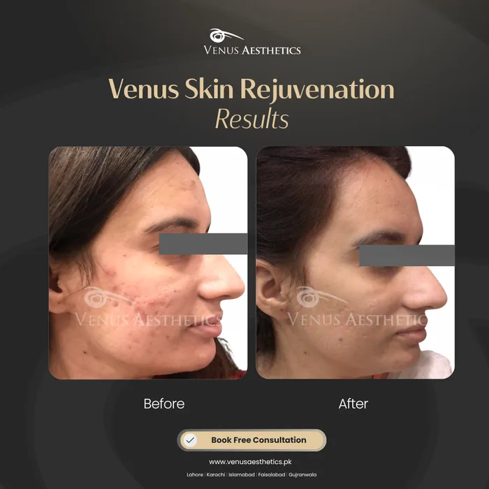 Acne Scars before and after result at Venus Aesthetics