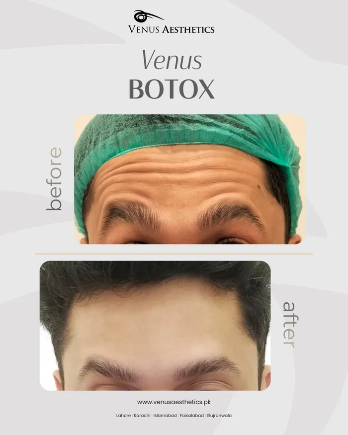 Forehead & Frown Lines at Venus Aesthetics