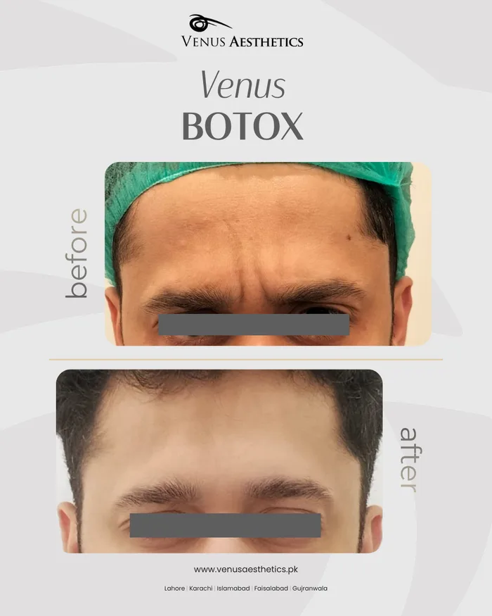 Botox before and after result at Venus Aesthetics