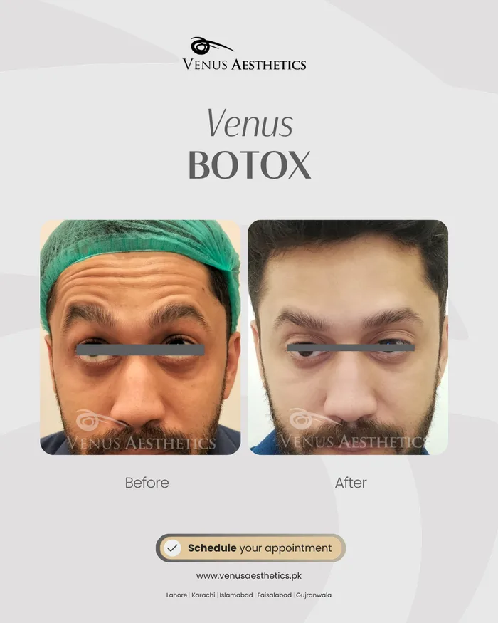 Forehead & Frown Botox before and after result at Venus Aesthetics