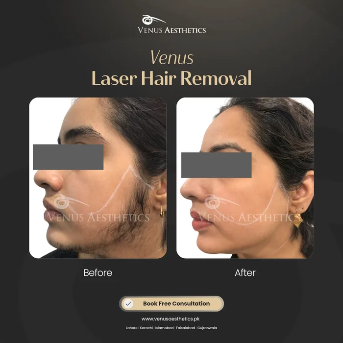Laser Hair Removal before and after result at Venus Aesthetics