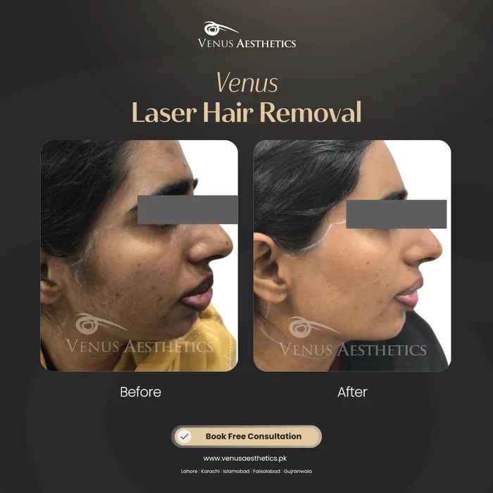 Laser Hair Removal before and after result at Venus Aesthetics