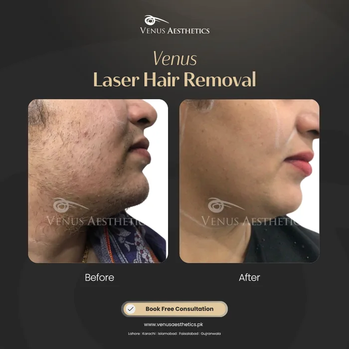 Laser Hair Removal before and after result at Venus Aesthetics