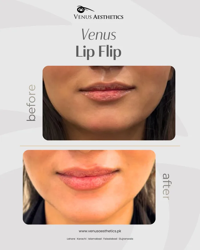 Botox lip flip before and after at Venus Aesthetics