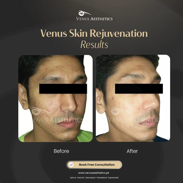 Venus Clear · Pigmentation before and after result at Venus Aesthetics
