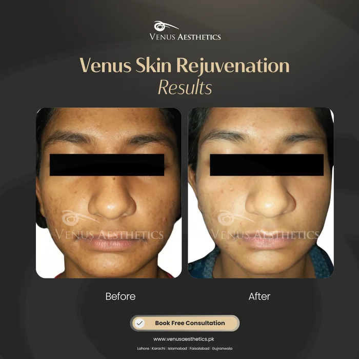 Venus Clear · Pigmentation before and after result at Venus Aesthetics