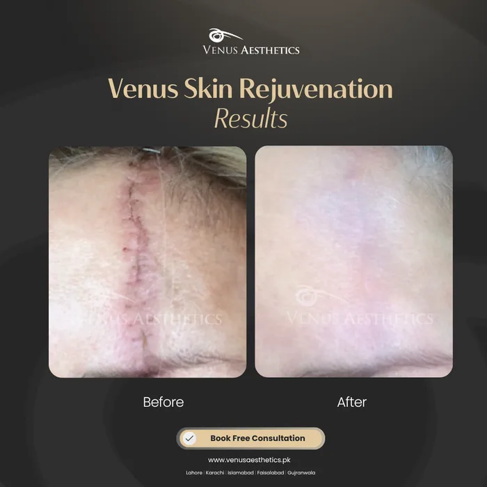 Scar Removal before and after result at Venus Aesthetics