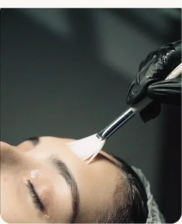 Acne therapy skin preparation at Venus Aesthetics clinic