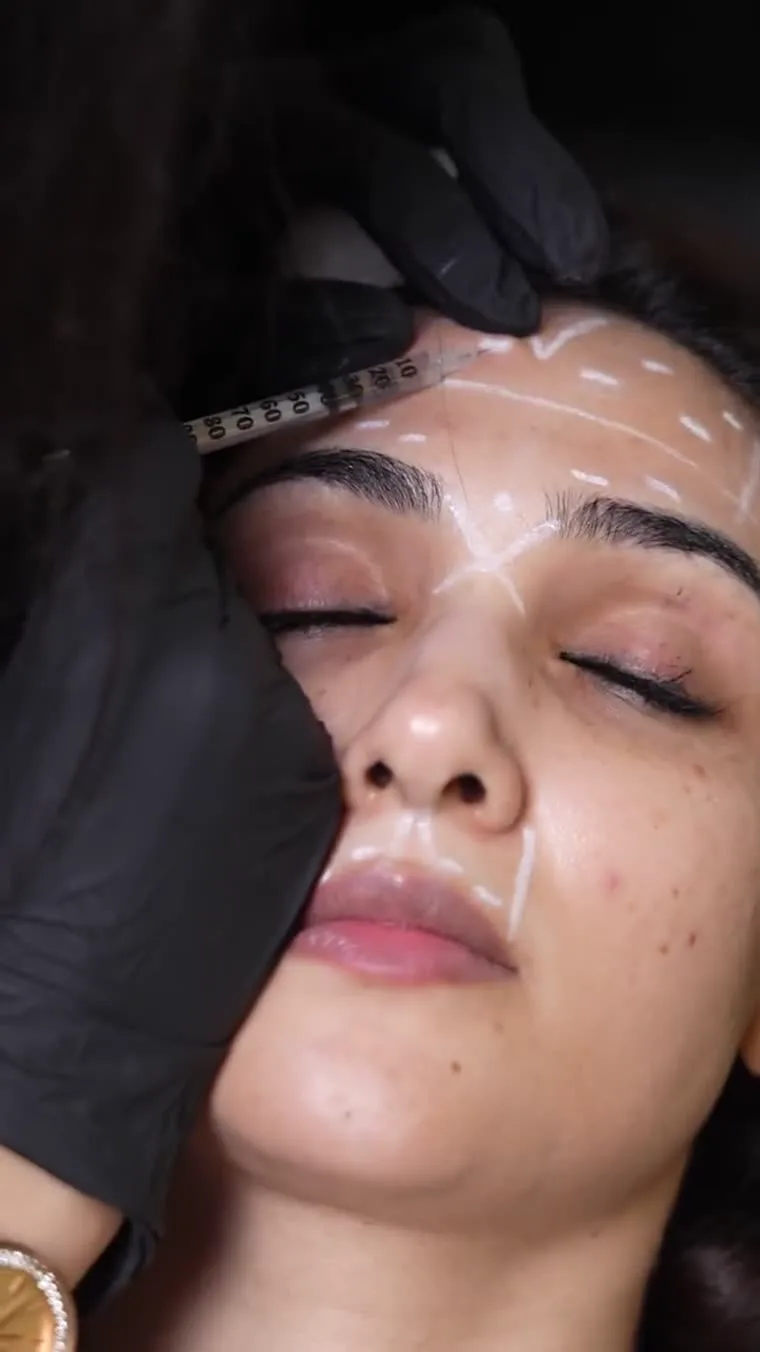 Botox forehead lines before and after at Venus Aesthetics