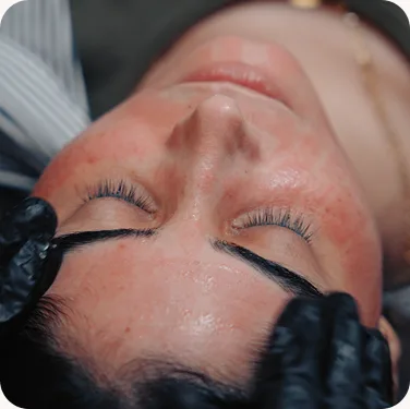 Gentle facial treatment for redness-prone skin at Venus Aesthetics