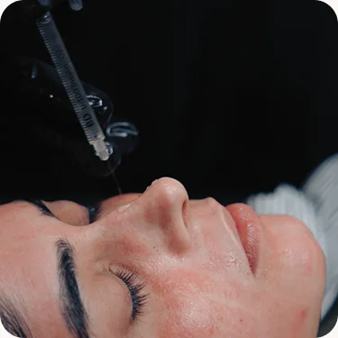 Medical-grade peel application at Venus Aesthetics