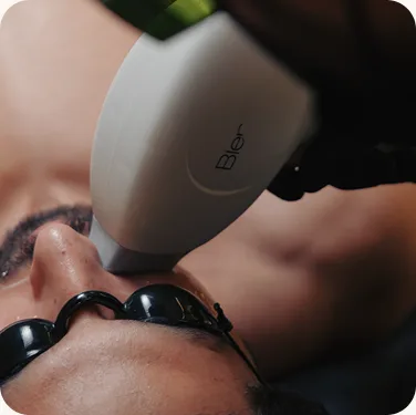 Upper arm treatment session at Venus Aesthetics