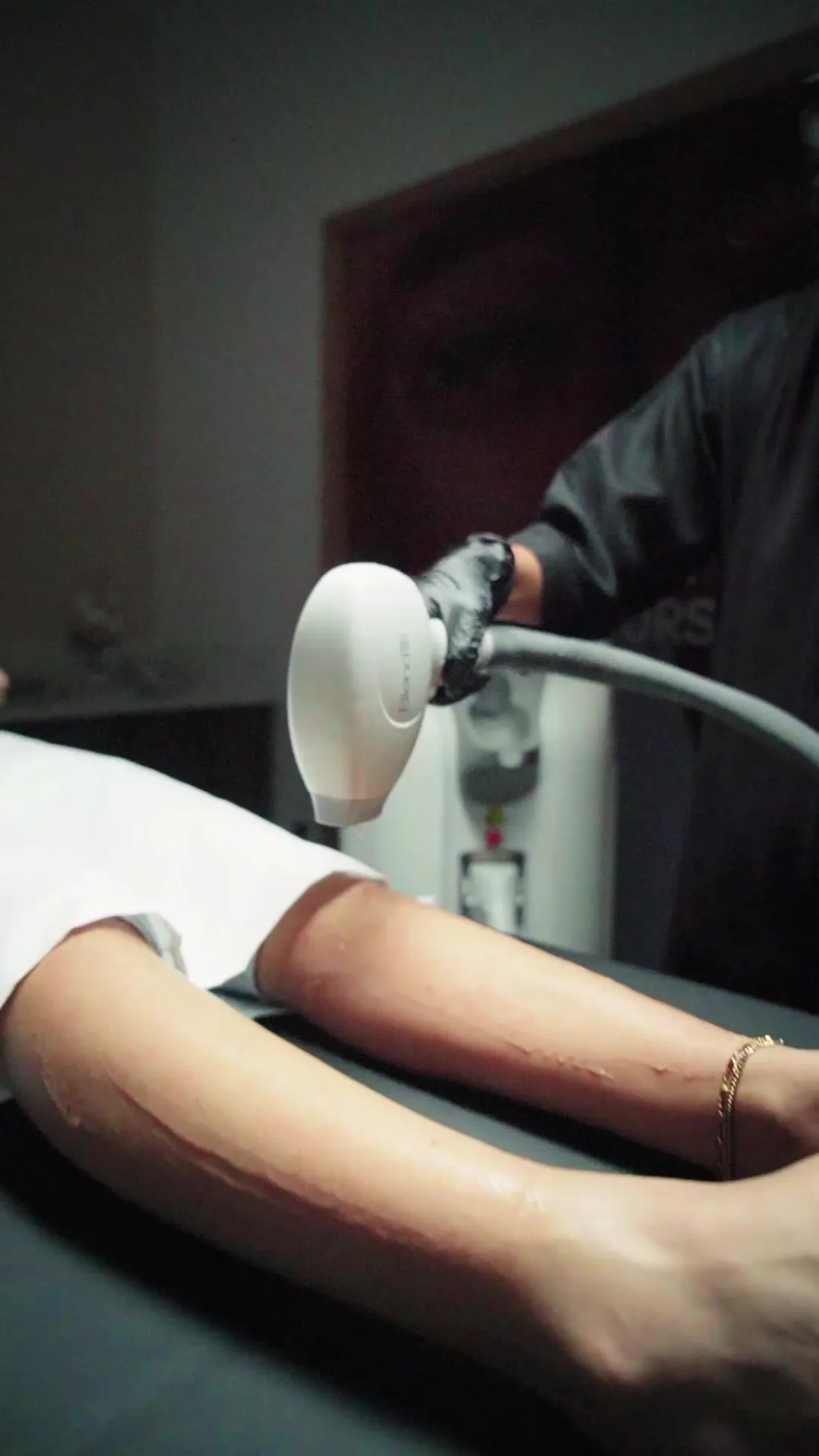 Medical-grade diode laser hair removal session at Venus Aesthetics